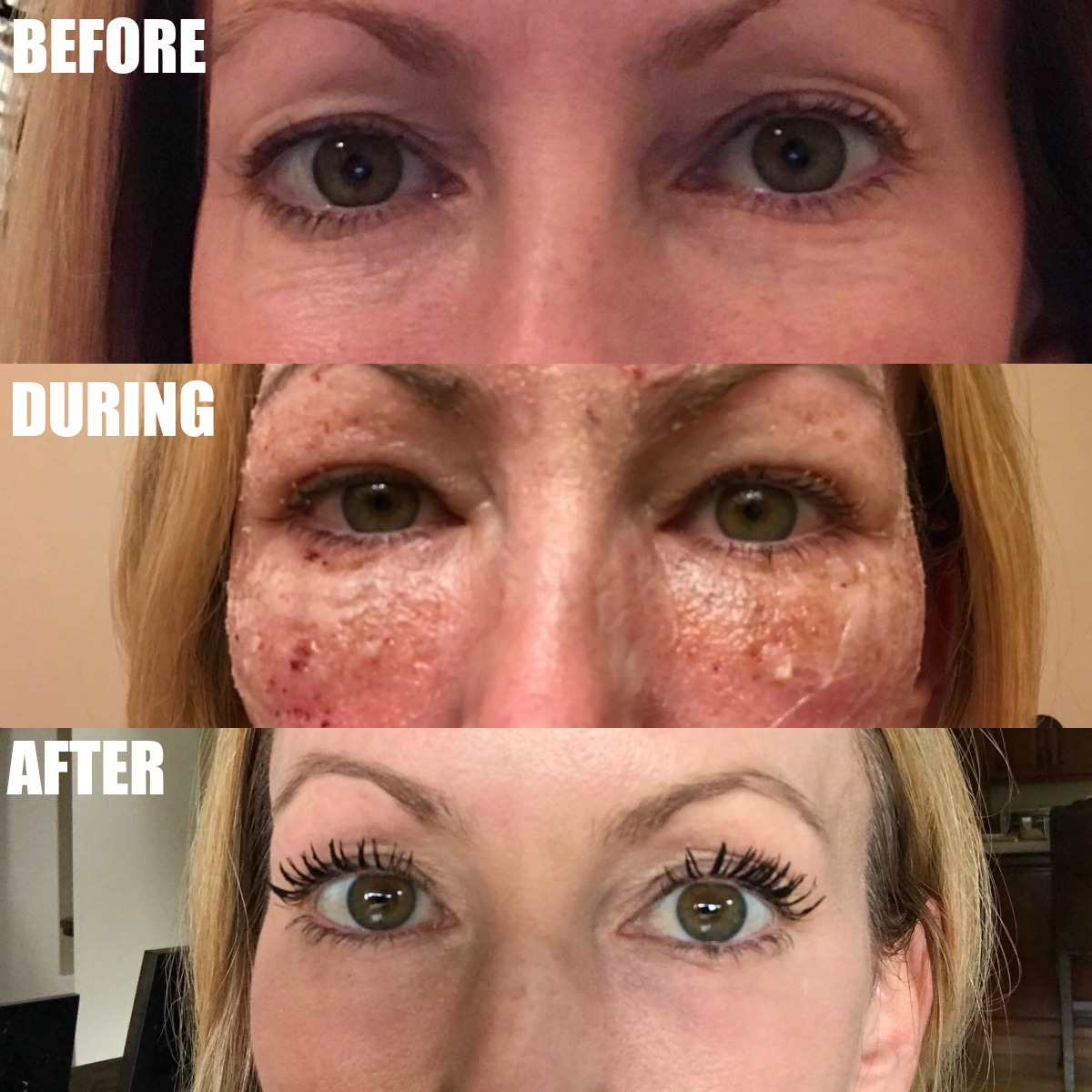 The Stylish Housewife CO2 Laser Before And After Archives The Stylish 